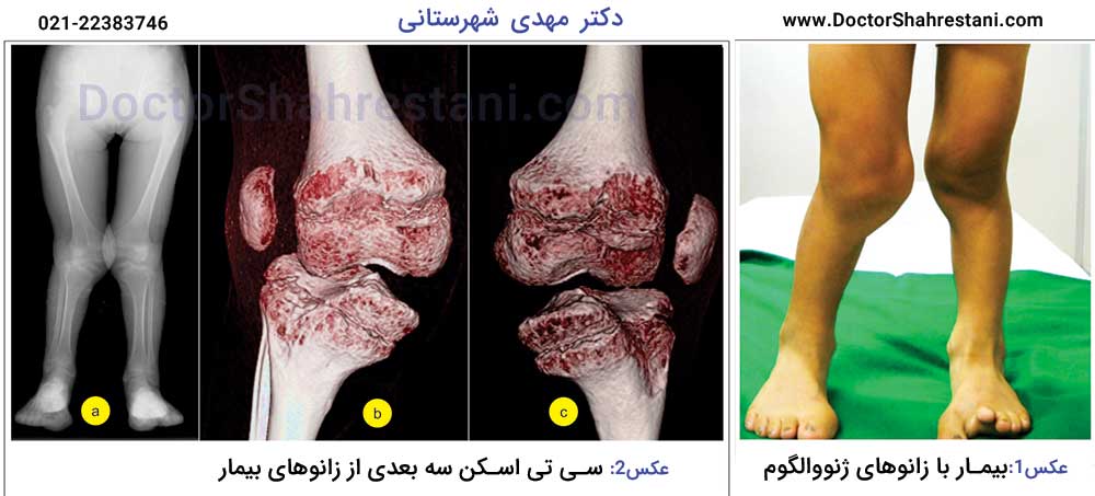 جراحی زانوی ضربدری یا ایکسی